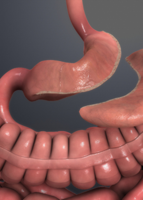 Cirurgia da Obesidade