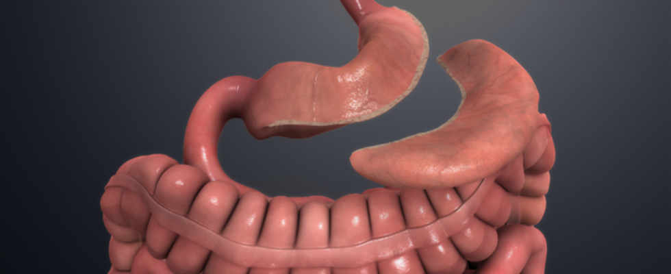 Cirurgia da Obesidade