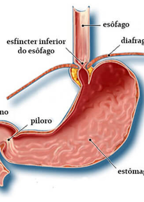  Cirurgia do Refluxo Gastroesofágico