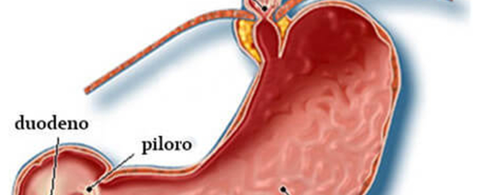  Cirurgia do Refluxo Gastroesofágico